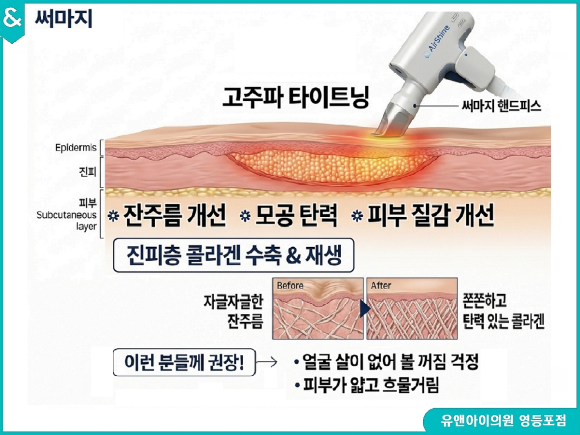 울쎄라피프라임 vs 써마지, 어떤 게 좋을까? 관련 이미지 3