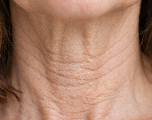 목주름 벨로테로, 티 나지 않게 개선하고 싶다면? 관련 이미지 7