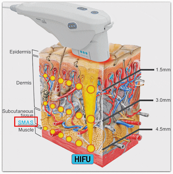 울타늄(울쎄라+티타늄) 효과, 왜 굳이 두 가지나 받을까? 관련 이미지 3