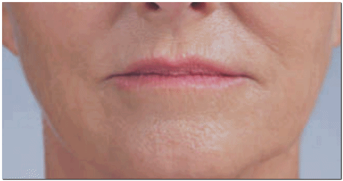 영등포 입술필러, 입술로 인상이 변할 수 있다고요? 관련 이미지 1