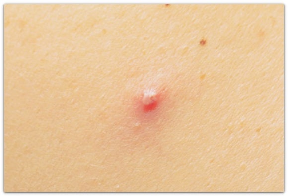 영등포여드름피부과 진료, 재발과 흉터 어떻게 막을까? 관련 이미지 3