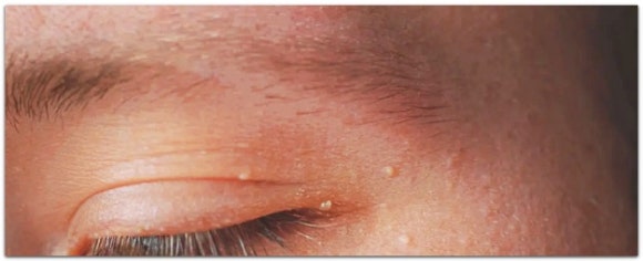 영등포편평사마귀, 병원에서 제거 전 OO부터 하는 이유 관련 이미지 3