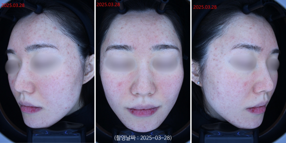 영등포 여드름 홍조 치료 사례 관련 이미지 2