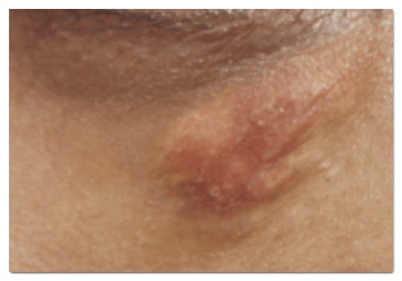 영등포쥬베룩 효과부터 결절 부작용까지 총정리 관련 이미지 5