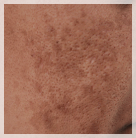 Mullae Dermatology Clinic: Differences in Skin Concerns You Should Know Before Your Appointment image 4