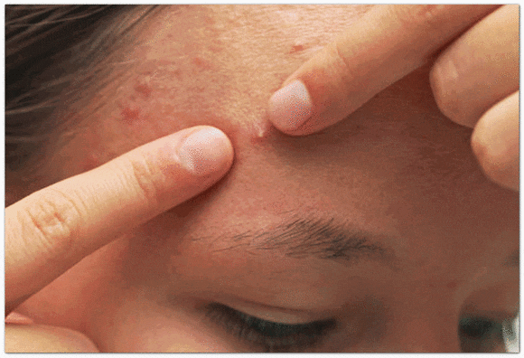 영등포여드름피부과 진료, 같은 자리에 자꾸 재발한다면? 관련 이미지 1