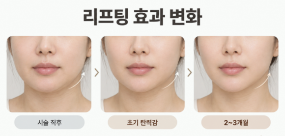 영등포써마지리프팅, 효과가 바로 나타나지 않는 이유가 궁금하다면? 관련 이미지 3