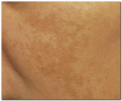 실펌x 레이저 효과 추천대상 통증은 어떨까? 관련 이미지 6