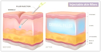 영등포역 필러 피부과 진료, 벨로테로 이마 팔자주름 효과, 그리고 중요한 것은? 관련 이미지 2