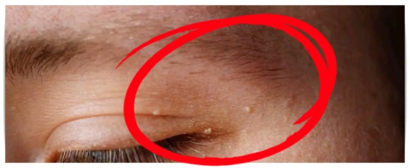 영등포편평사마귀 원인 특징 제거법 확인하세요 관련 이미지 4