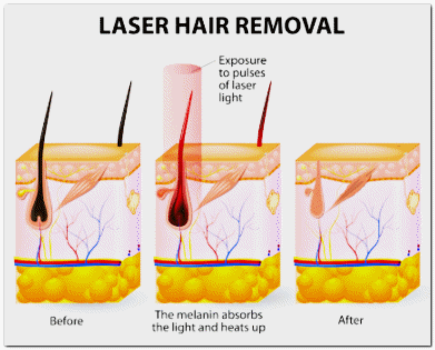 영등포제모, 왜 젠틀맥스 프로플러스 추천이 많을까? 관련 이미지 2