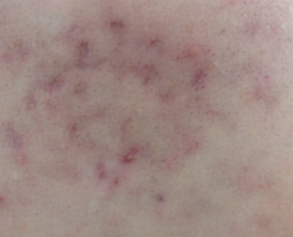 영등포 여드름흉터, 효과 보려면 이 방법부터 확인하세요 관련 이미지 2