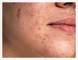 Yeongdeungpo Acne Scars: Which Treatment Does My Case Need? image 8