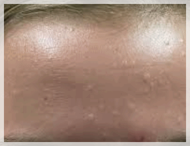 Flat Warts in Yeongdeungpo: You Need to Examine the Causes of Recurrence First image 7