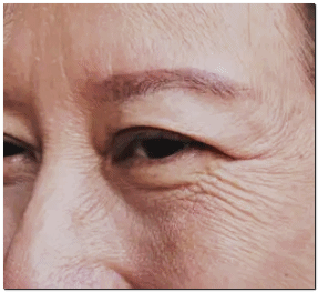 아이울쎄라피 프라임, 기대했는데 효과 잘 못 봤다면? 관련 이미지 5