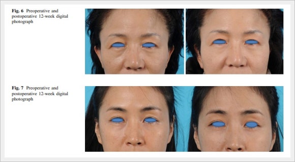 Does Eye Ulthera Work for Under-Eye Sagging? image 8