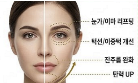 영등포울쎄라피프라임 기존 울쎄라와 어떻게 다른가요? 관련 이미지 3