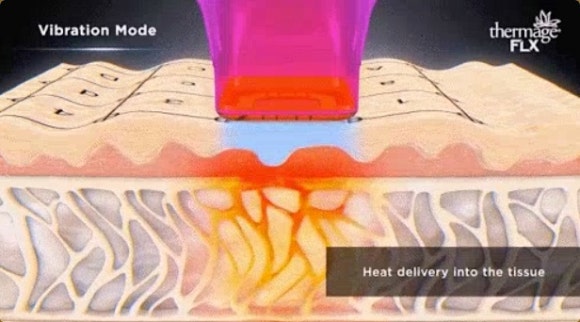 써마지 리쥬란 병행 효과와 주의할 점 정리 관련 이미지 2