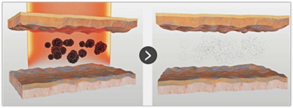 영등포잡티제거 시술, 1회 관리로 없어진다는 말 사실일까? 관련 이미지 4