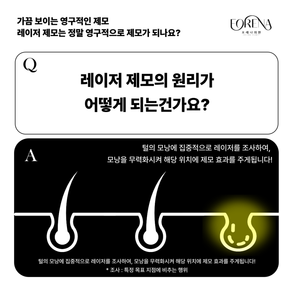 레이저 제모는 영구적이기도 반영구적이기도 하다? 이게 무슨말이죠? 레이저 제모 VS 왁싱 차이점까지!🤔 관련 이미지 4