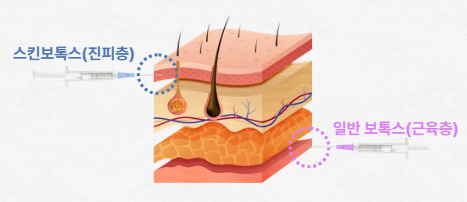 Skin Botox Q&A | A Guide to Its Principles and Features image 10