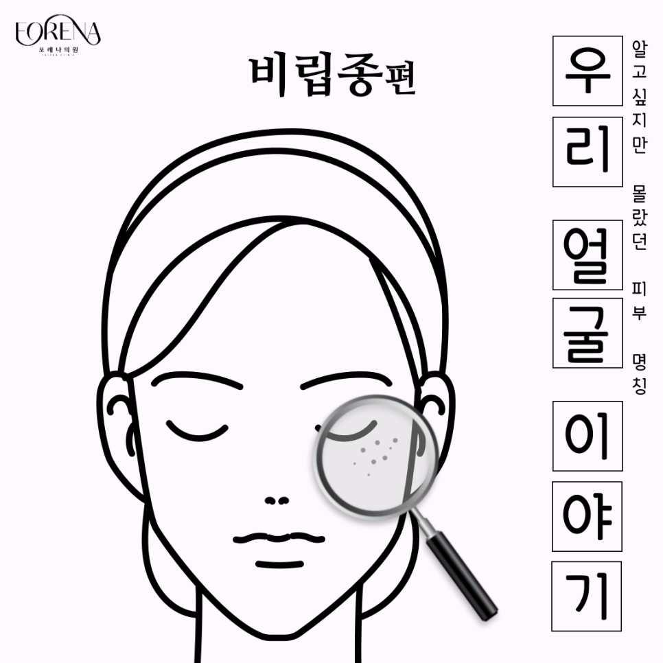 비립종에 대해 하나부터 열까지 알아보자! 👀 관련 이미지 2