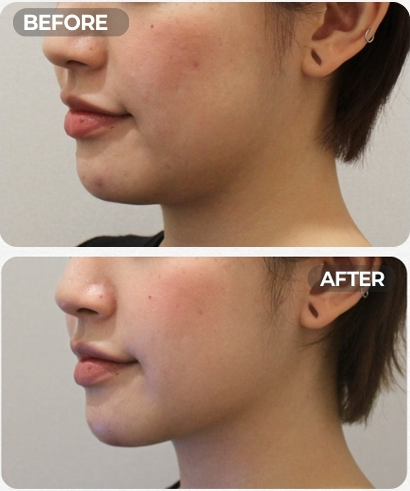 온다리프팅 Q&A | 시술 원리와 특징 정리 관련 이미지 4