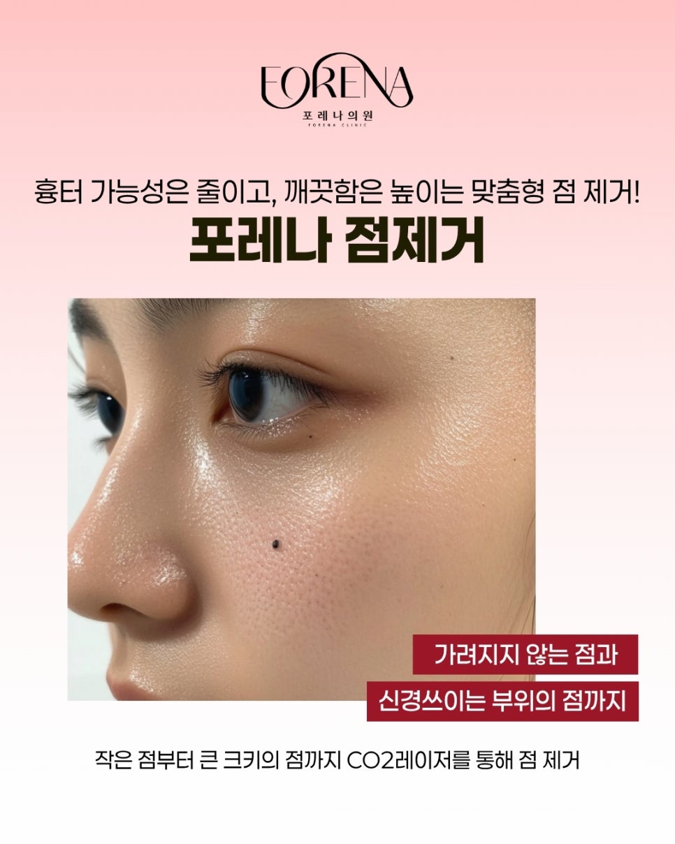 포레나 점제거 시술이란? 관련 이미지 3