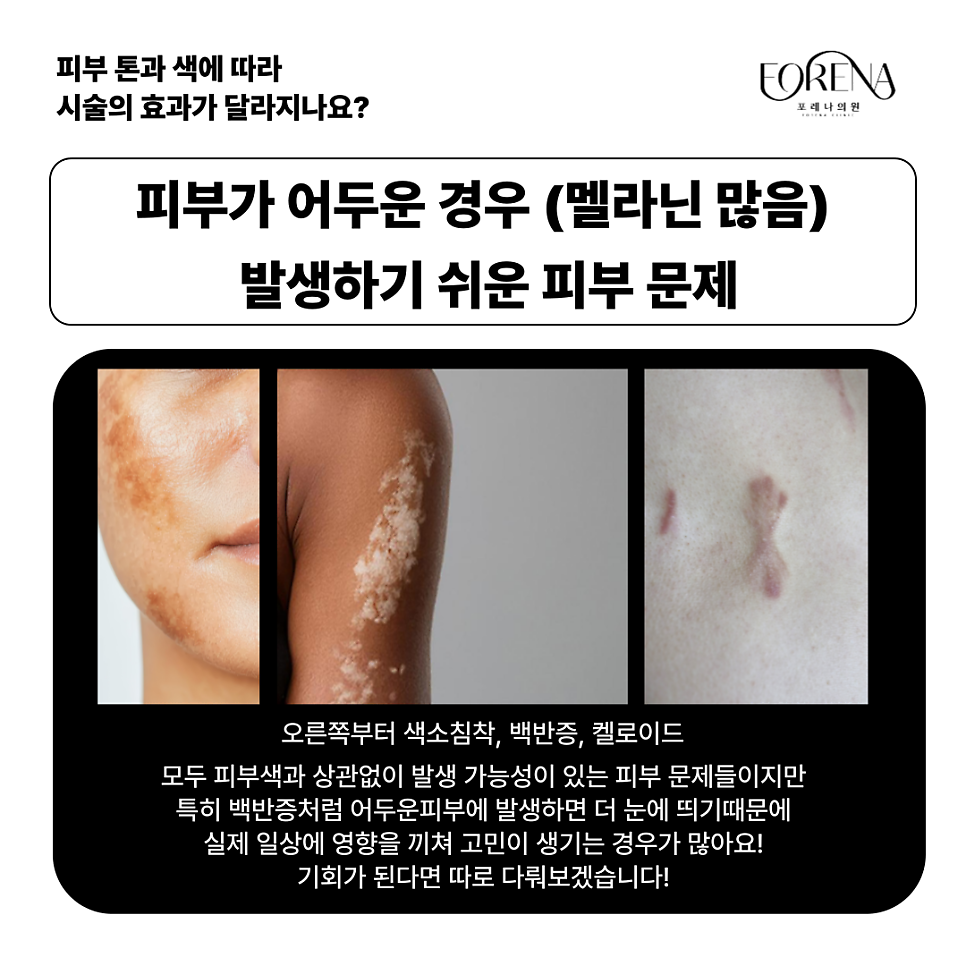 피부색에 따라 피부과 시술효과가 달라지나요? 하얀 피부 VS 어두운 피부🤍🖤 관련 이미지 5