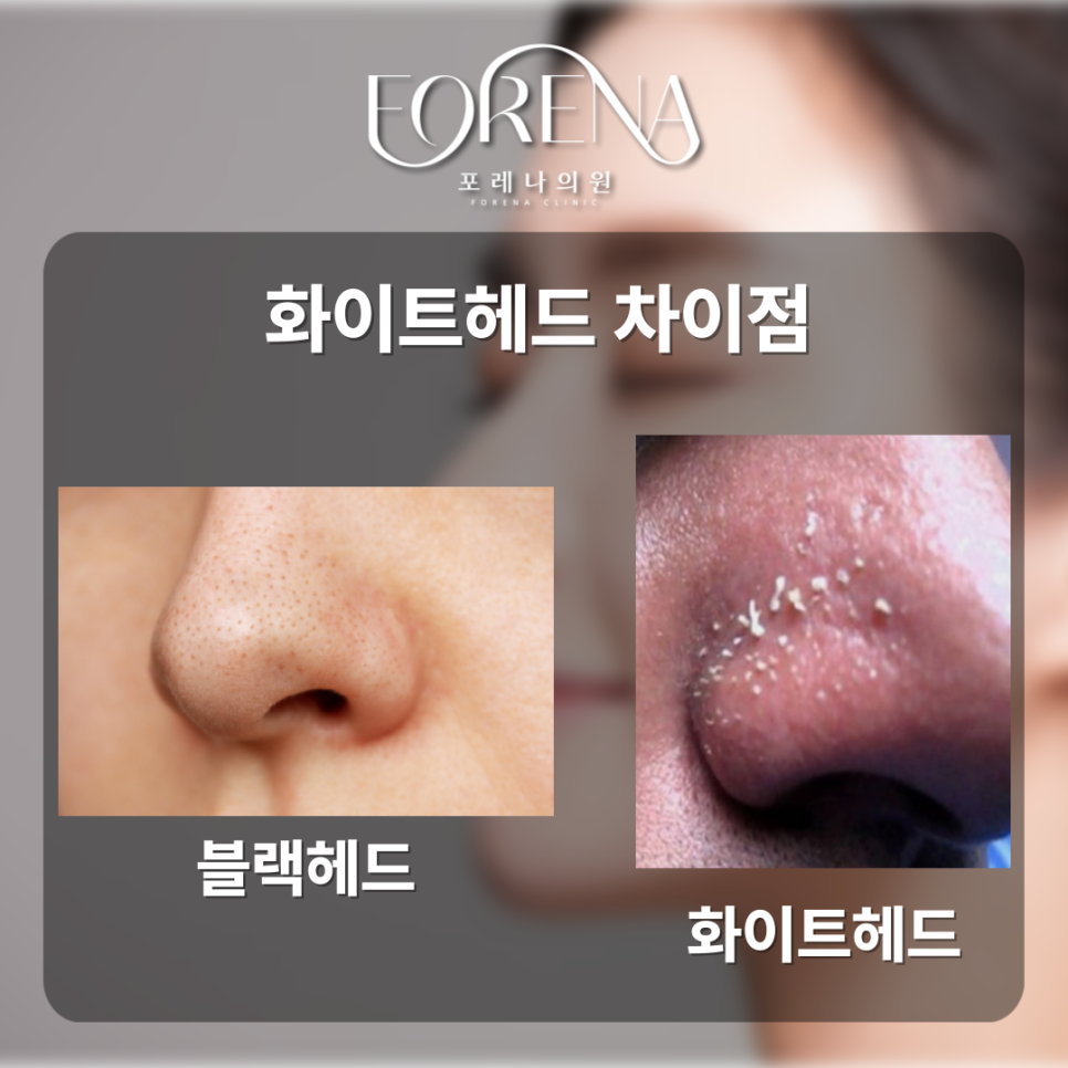 화이트헤드가 대체 뭐야? 블랙헤드랑 비슷한건가? 화이트헤드 설명해드립니다. 관련 이미지 6