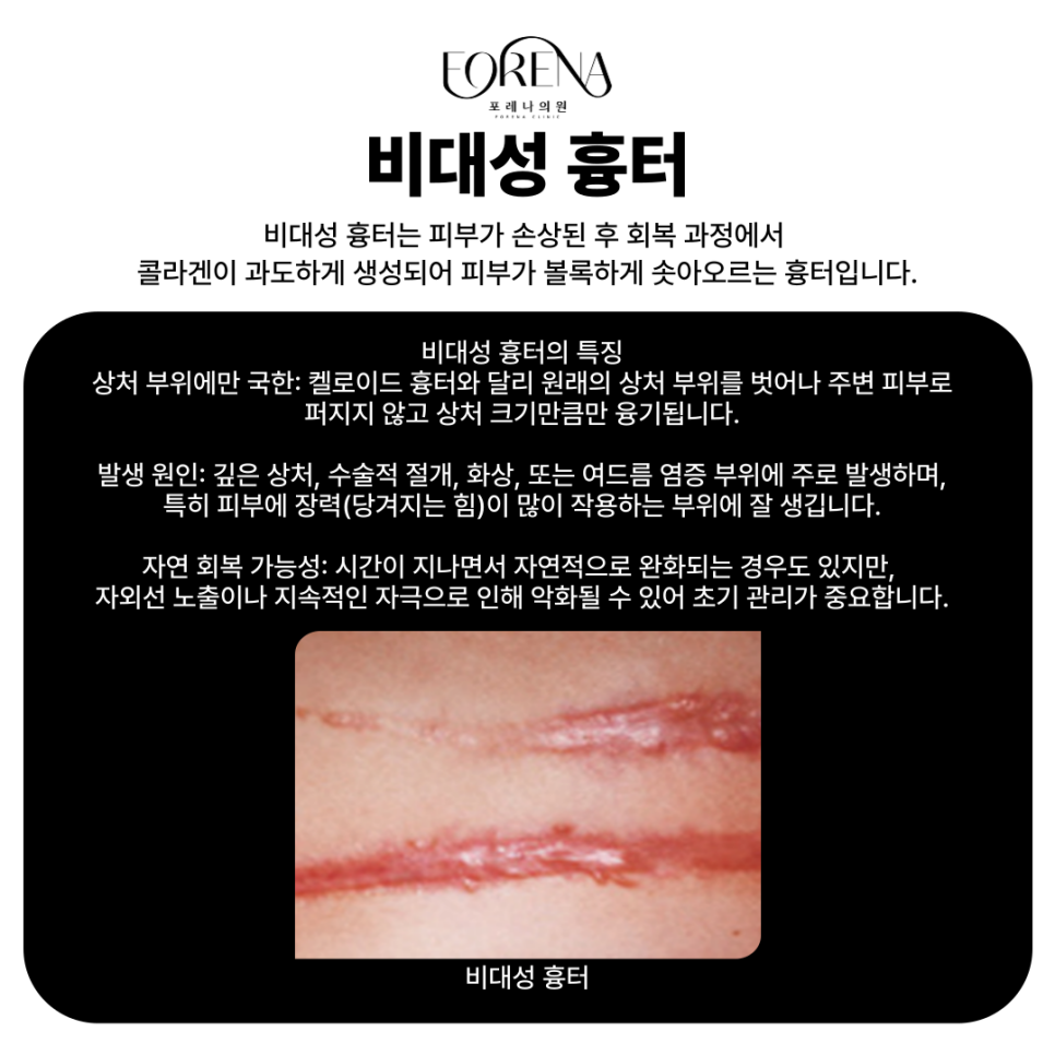 여드름 흉터 종류에 대해 알아보자! 위축성 흉터부터 색소성 흉터까지 한번에 알아보기! 관련 이미지 4