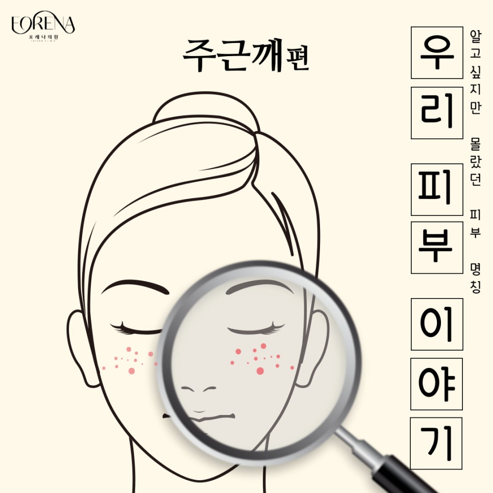 주근깨는 매력적이다? 주근깨에 대하여 자세히 알아보자! 관련 이미지 2