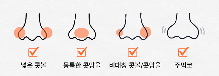 Nose-Sculpting Injection Q&A | An Overview of the Procedure’s Principles and Features image 10