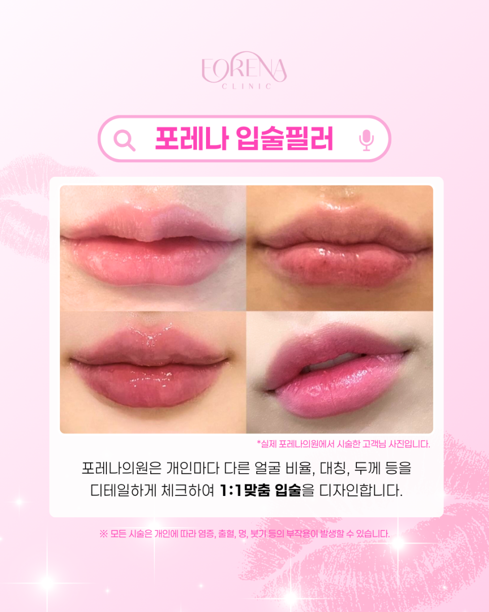 홍대피부과 입술필러, 아직도 용량만 고민하시나요? 관련 이미지 3