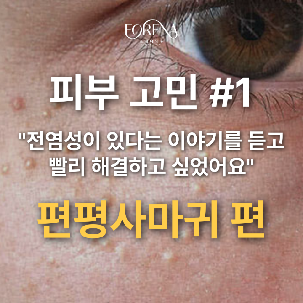 보기도 흉한데 전염성까지 있다고? 편평사마귀를 알아보자🥹 관련 이미지 2