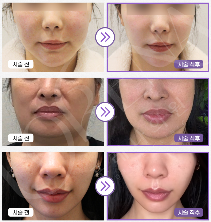 피부와 몸이 반응하는 줄기세포IV 관련 이미지 3