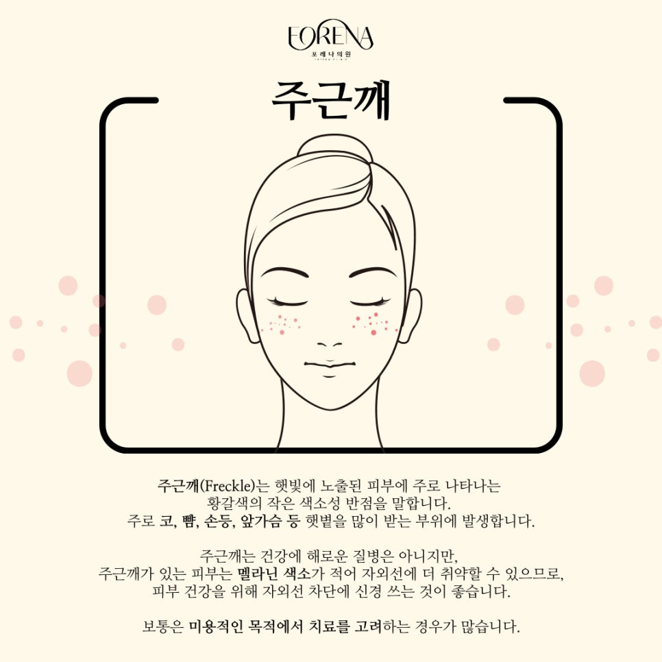 주근깨는 매력적이다? 주근깨에 대하여 자세히 알아보자! 관련 이미지 3