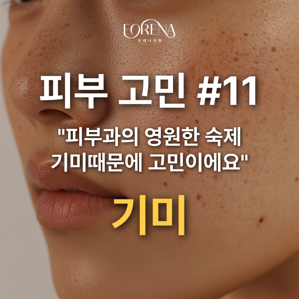 표피형, 진피형, 혼합형, 난치성 기미 고민 나한테 있는 기미는 어떤 종류일까?💧 관련 이미지 2
