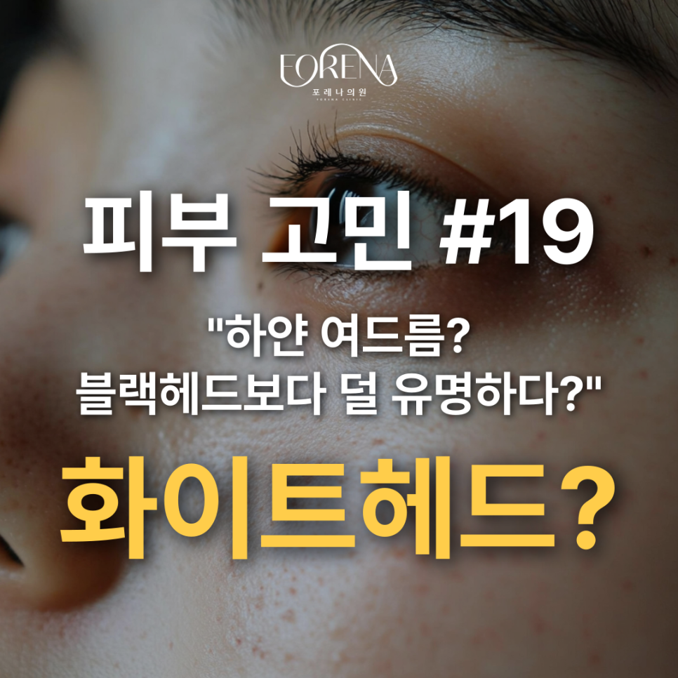 화이트헤드가 대체 뭐야? 블랙헤드랑 비슷한건가? 화이트헤드 설명해드립니다. 관련 이미지 2