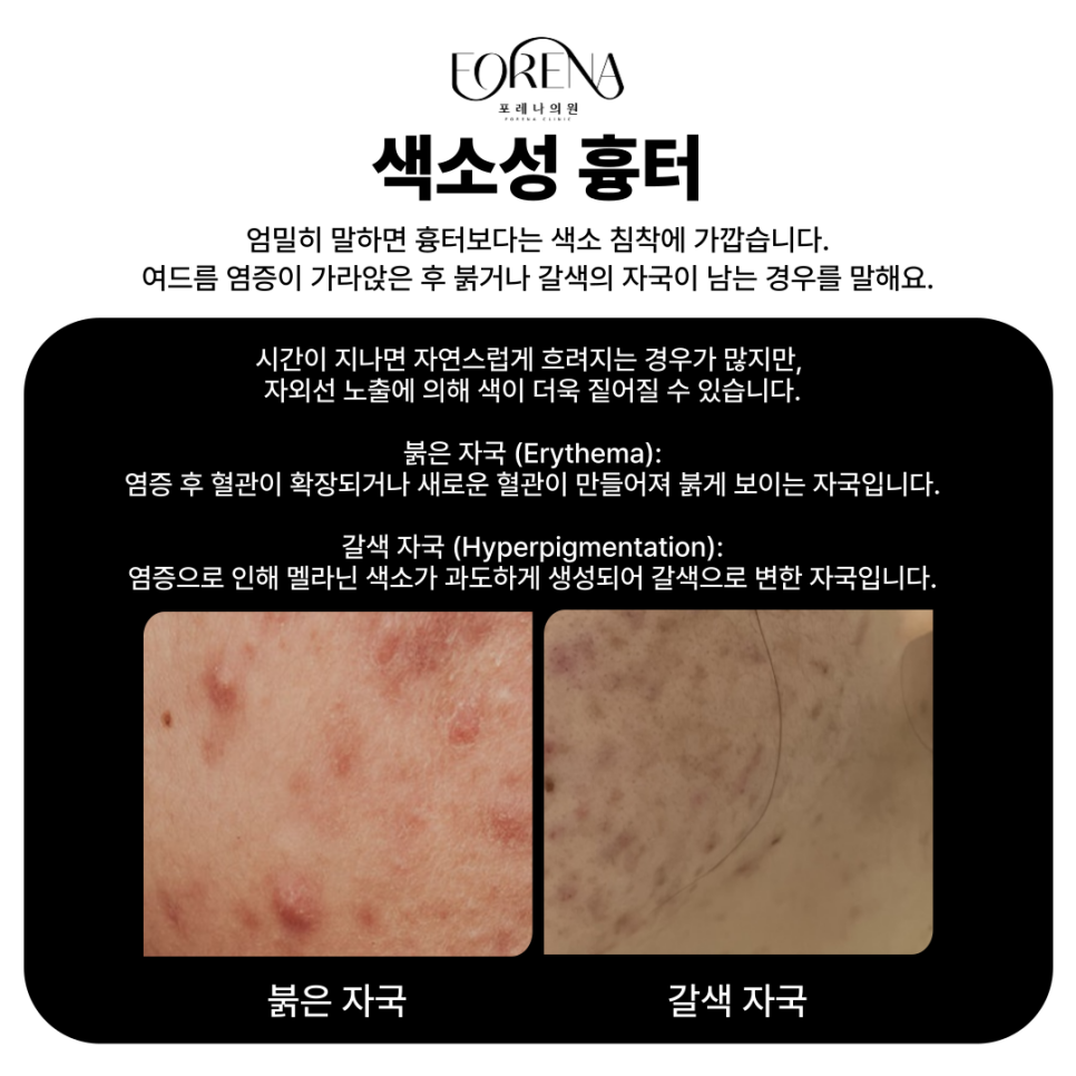 여드름 흉터 종류에 대해 알아보자! 위축성 흉터부터 색소성 흉터까지 한번에 알아보기! 관련 이미지 5