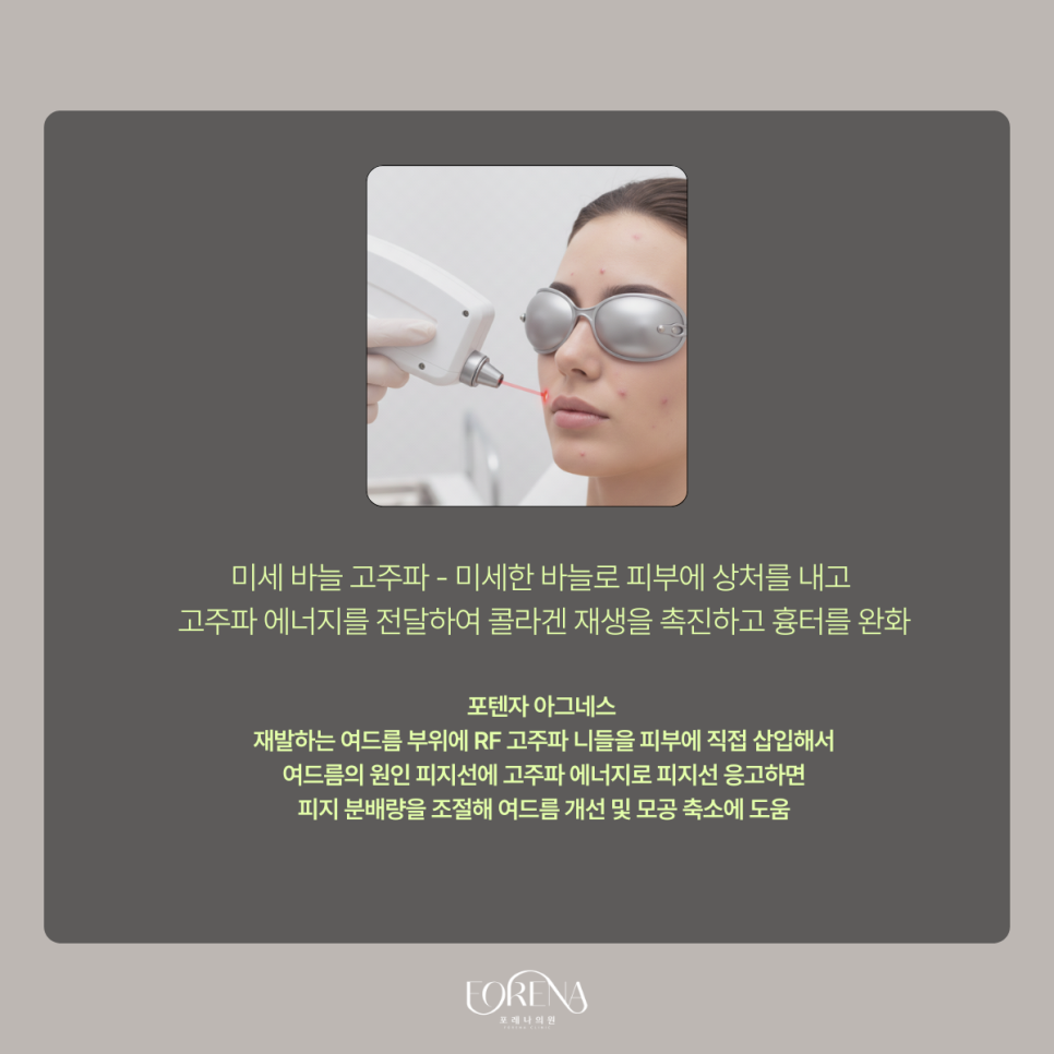 여드름 잘 생기는 부위는 따로 있다? 관련 이미지 8