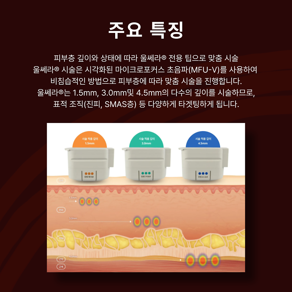 울쎄라 기기 정보를 알아보자 🔎 관련 이미지 4