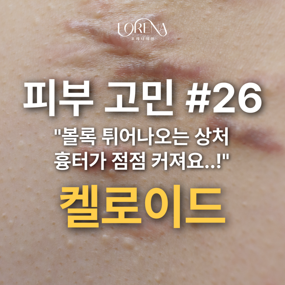 상처(흉터)가 점점 커지고 밖으로 튀어나오는 켈로이드 체질 관련 이미지 2