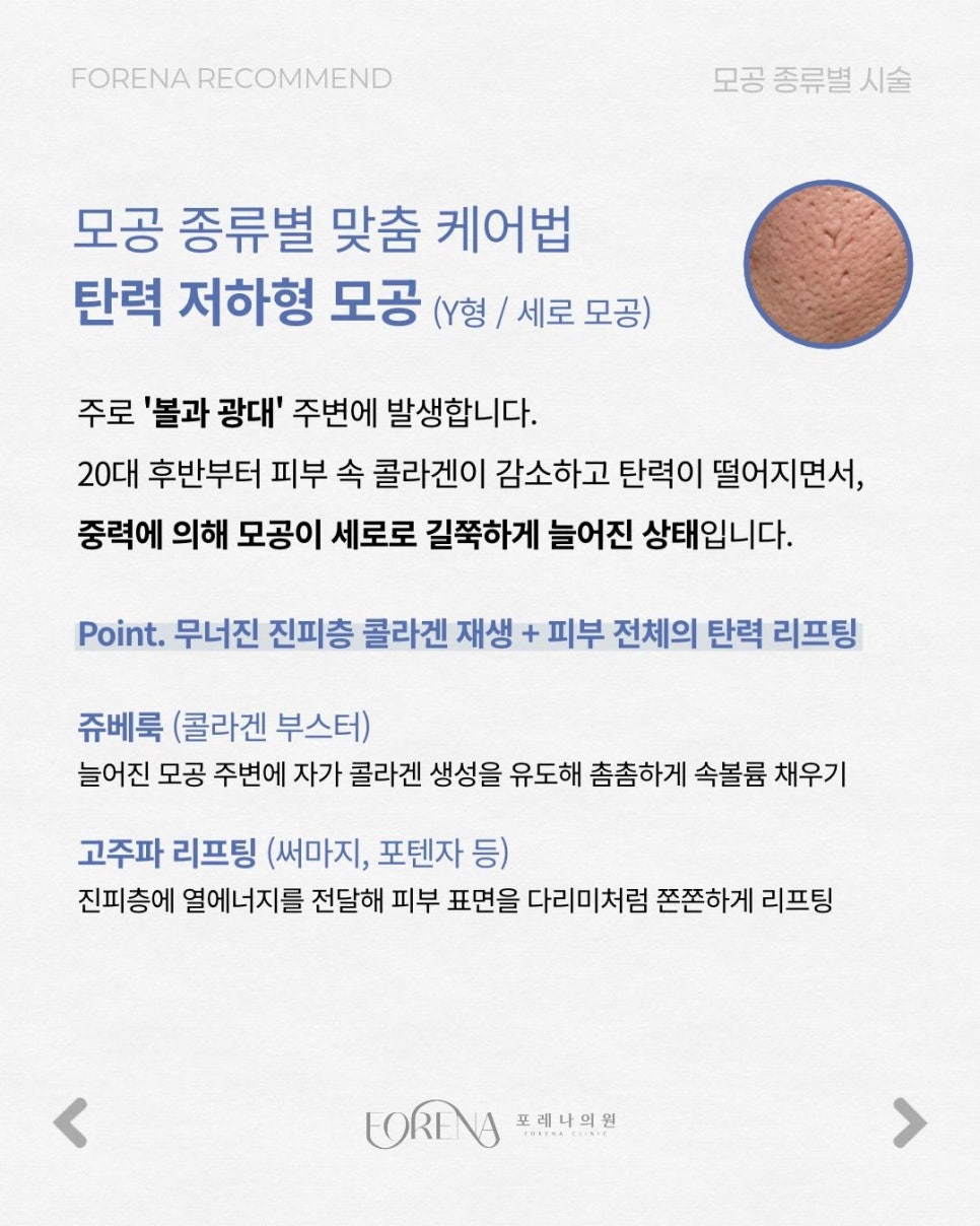모공 유형별 관련 이미지 4