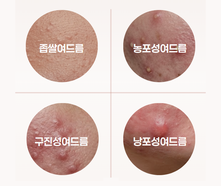 염증주사 Q&A | 시술 원리와 특징 정리 관련 이미지 3