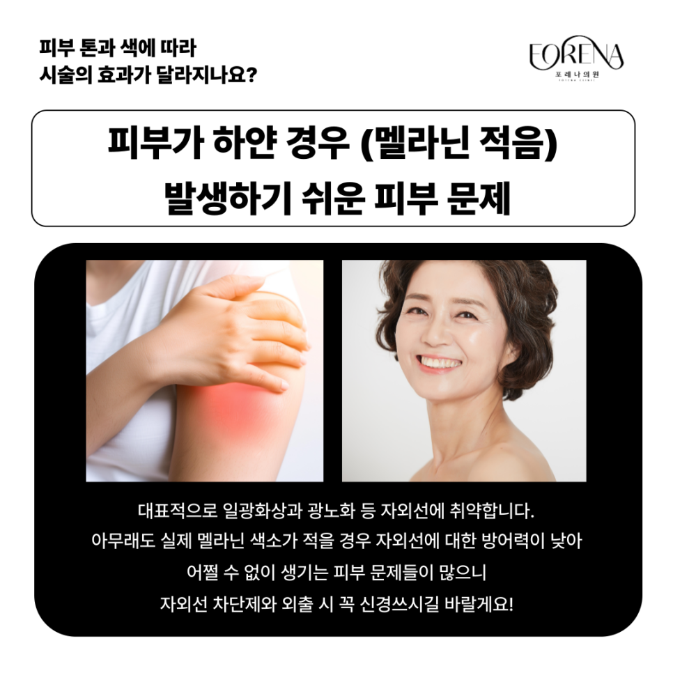 피부색에 따라 피부과 시술효과가 달라지나요? 하얀 피부 VS 어두운 피부🤍🖤 관련 이미지 6