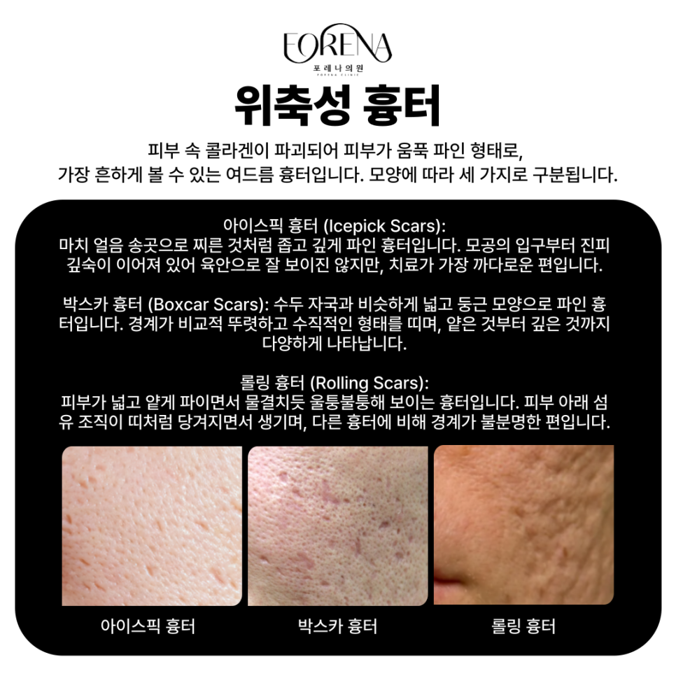 여드름 흉터 종류에 대해 알아보자! 위축성 흉터부터 색소성 흉터까지 한번에 알아보기! 관련 이미지 3