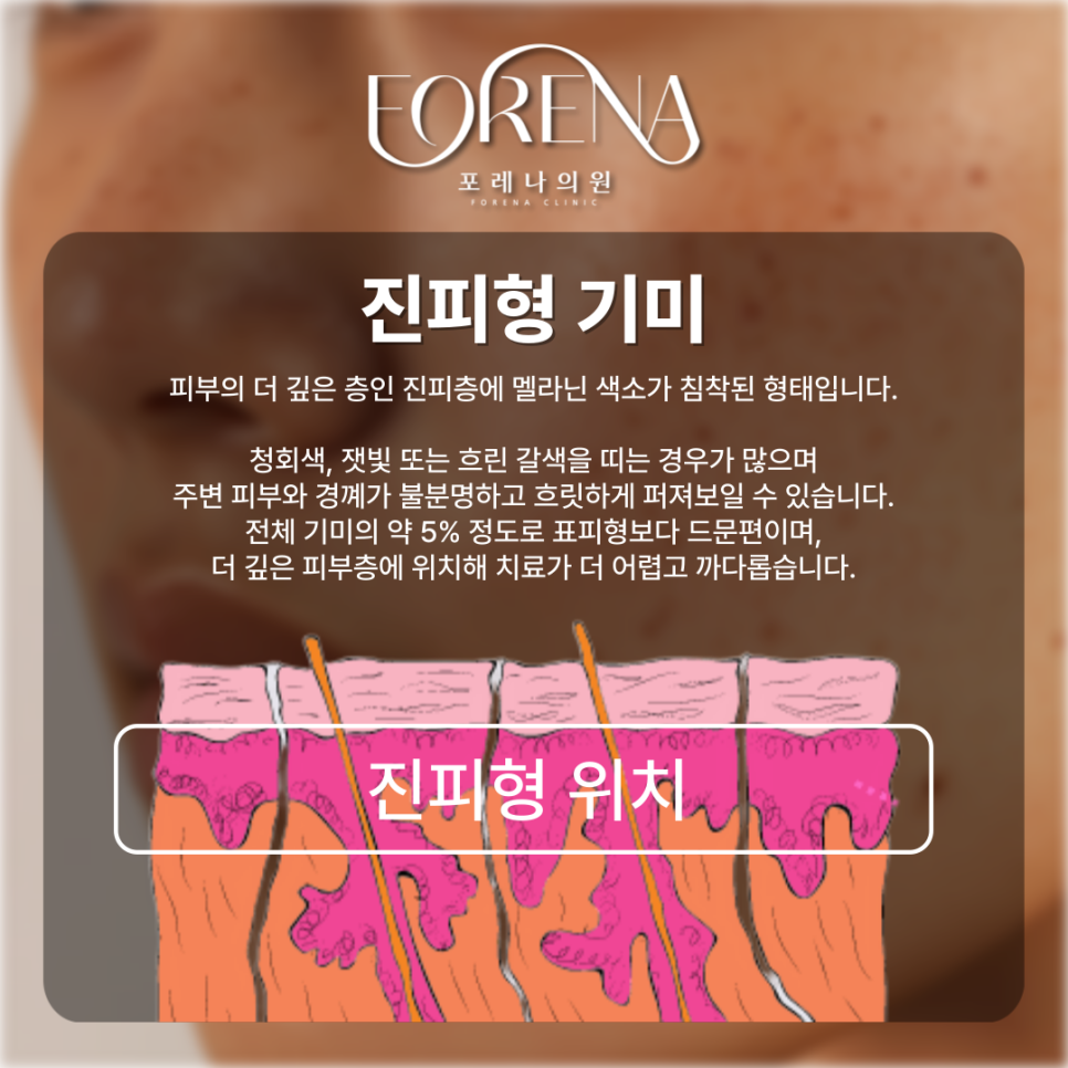 표피형, 진피형, 혼합형, 난치성 기미 고민 나한테 있는 기미는 어떤 종류일까?💧 관련 이미지 6