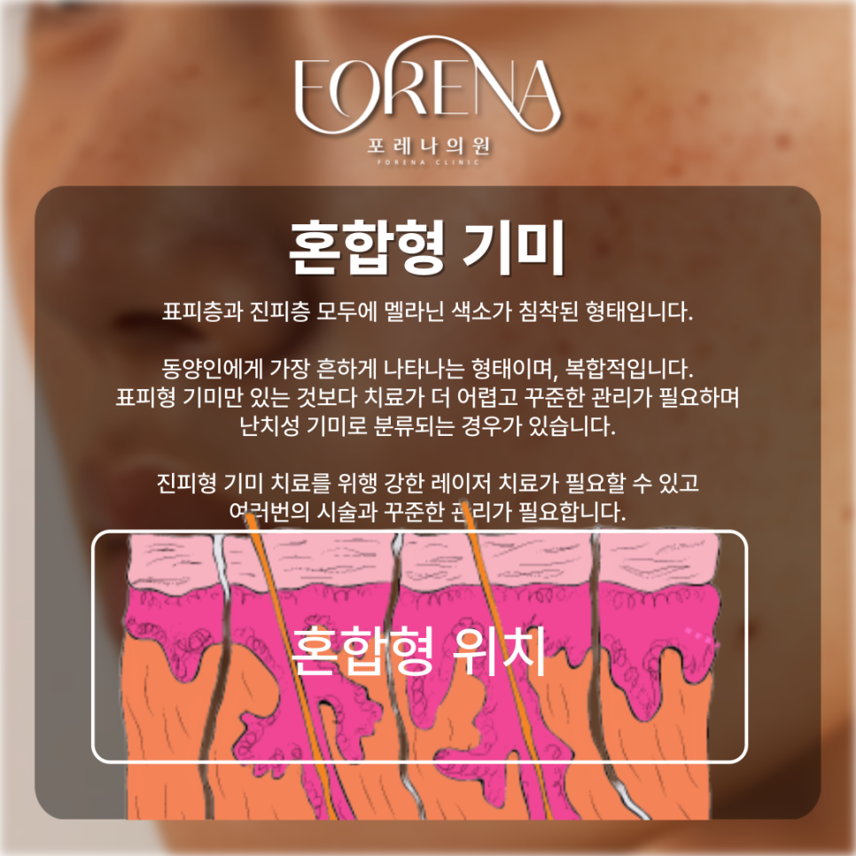 표피형, 진피형, 혼합형, 난치성 기미 고민 나한테 있는 기미는 어떤 종류일까?💧 관련 이미지 7