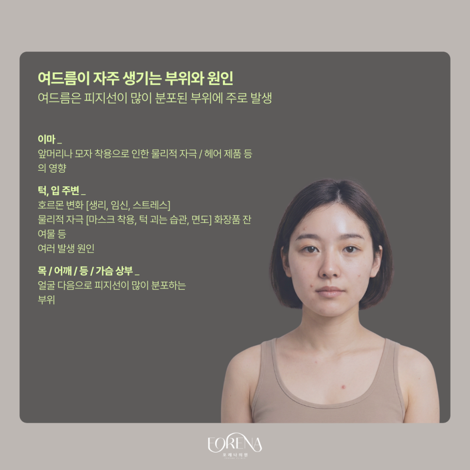 여드름 잘 생기는 부위는 따로 있다? 관련 이미지 5
